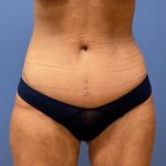 Tummy Tuck Before & After Patient #8636