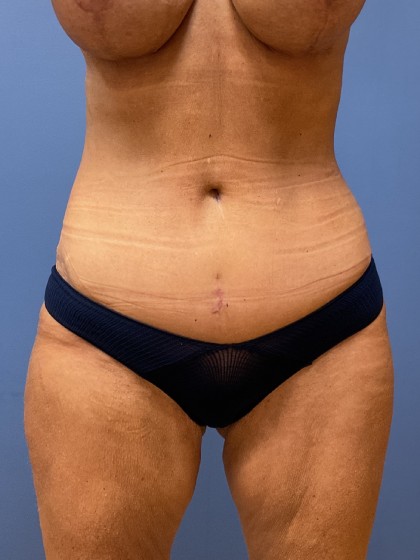 Tummy Tuck Before & After Patient #8636