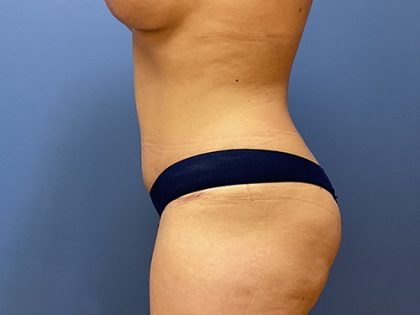 Tummy Tuck Before & After Patient #8764