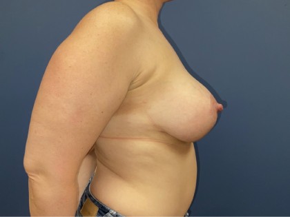 Breast Augmentation + Lift Before & After Patient #8654