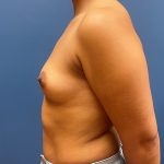 Breast Augmentation Before & After Patient #8702