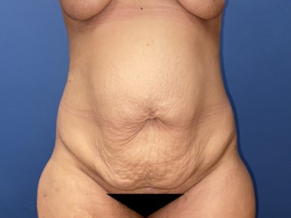 Tummy Tuck Before & After Patient #8764