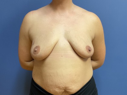Breast Augmentation + Lift Before & After Patient #8775