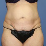 Tummy Tuck Before & After Patient #8670