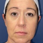 Facelift Before & After Patient #8681