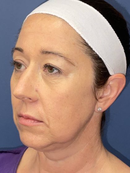 Facelift Before & After Patient #8681