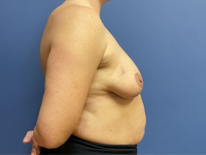 Breast Augmentation + Lift Before & After Patient #8775