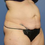 Tummy Tuck Before & After Patient #8670