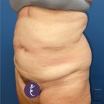Tummy Tuck Before & After Patient #8647