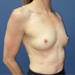 Breast Augmentation Before & After Patient #8746