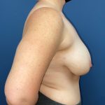 Breast Reduction Before & After Patient #8741