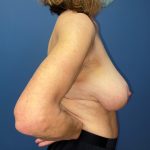 Breast Reduction Before & After Patient #8734
