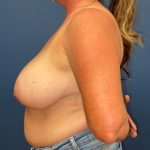 Breast Reduction Before & After Patient #8729