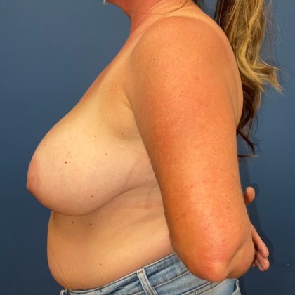 Breast Reduction Before & After Patient #8729