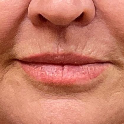 Lip Lift Before & After Patient #8695