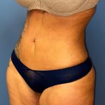 Liposuction Before & After Patient #8842
