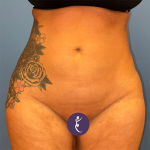 Liposuction Before & After Patient #8842