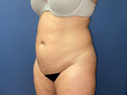 Tummy Tuck Before & After Patient #8905