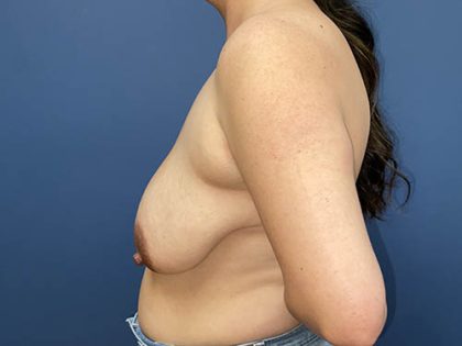 Breast Reduction Before & After Patient #8894