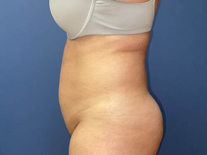 Tummy Tuck Before & After Patient #8905