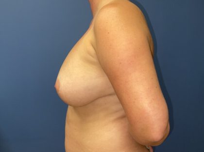 Breast Revision Before & After Patient #8927
