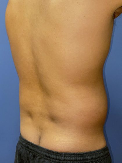Liposuction Before & After Patient #8868