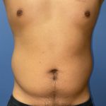 Liposuction Before & After Patient #8868