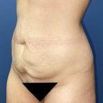Tummy Tuck Before & After Patient #9409
