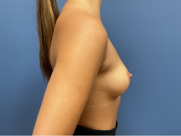 Breast Augmentation Before & After Patient #9088