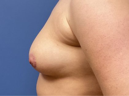 Nipple Reduction Before & After Patient #9438