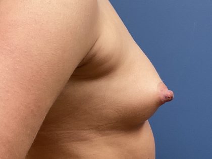 Nipple Reduction Before & After Patient #9438