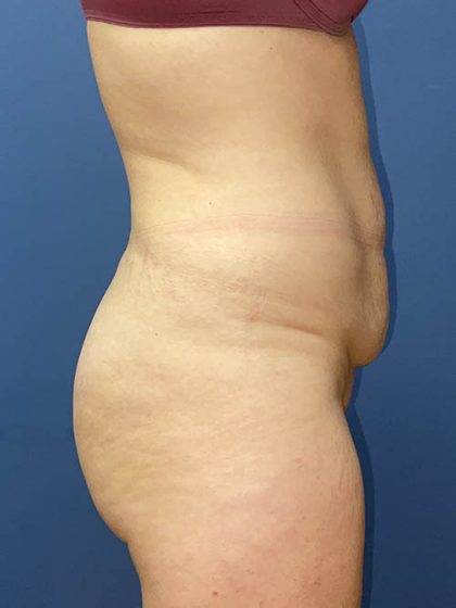 Tummy Tuck Before & After Patient #9409