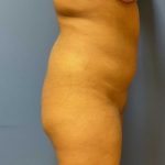 Brazilian Butt Lift Before & After Patient #9450