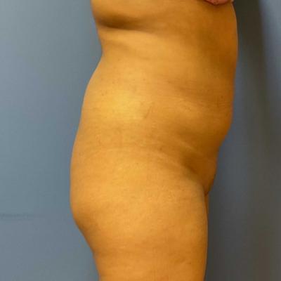 Brazilian Butt Lift Before & After Patient #9450