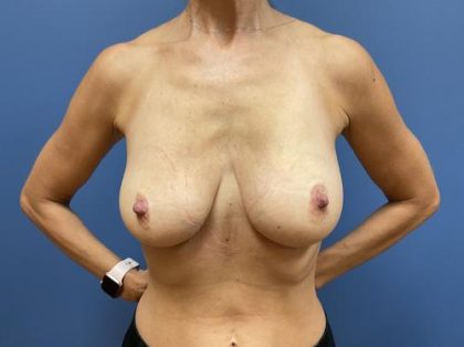 Breast Reduction Before & After Patient #9601