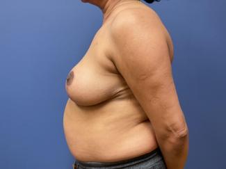 Breast Reduction Before & After Patient #9541