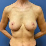 Breast Reduction Before & After Patient #9601