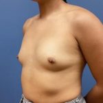 Breast Augmentation Before & After Patient #9529