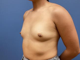 Breast Augmentation Before & After Patient #9529