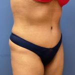 Liposuction Before & After Patient #9552