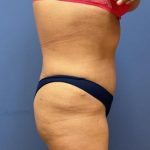 Liposuction Before & After Patient #9552