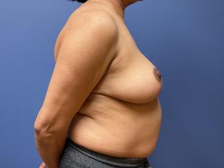 Breast Reduction Before & After Patient #9541