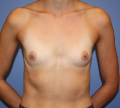 Breast Augmentation Before & After Patient #9668