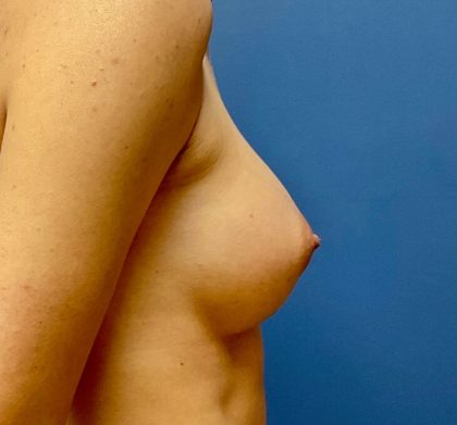 Breast Augmentation Before & After Patient #9676