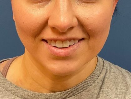 Buccal Fat Before & After Patient #9661