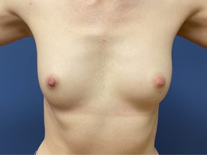 Nipple Reduction Before & After Patient #9683