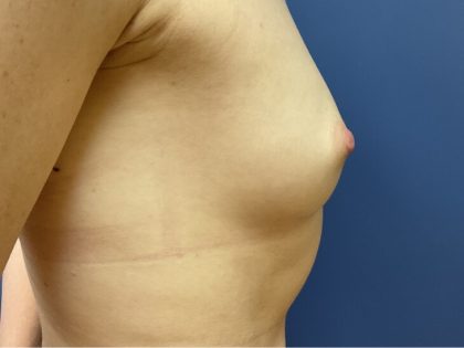 Nipple Reduction Before & After Patient #9683