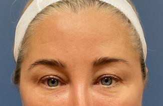Eyelid Lift Before & After Patient #9633
