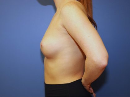 Breast Augmentation Before & After Patient #9806