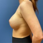 Breast Augmentation Before & After Patient #9806
